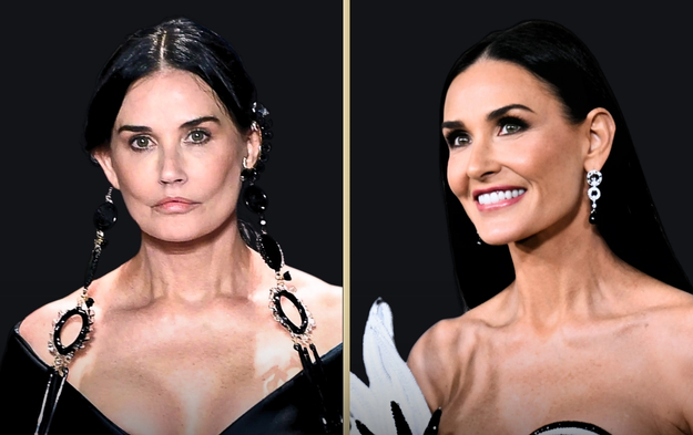 Demi Moore's Plastic Surgery- Before & After