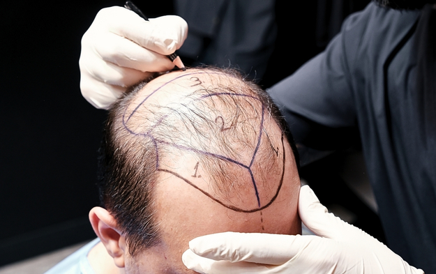 DHI Hair Transplant in Turkey- Cost 2025