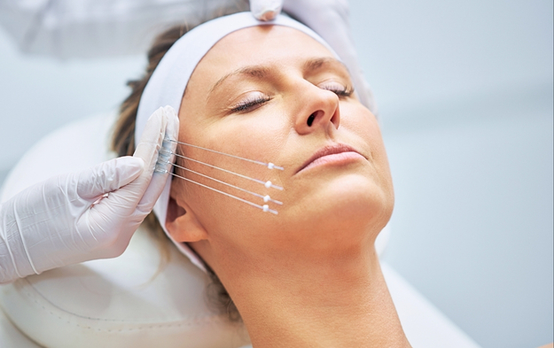 Thread Lift Procedure: A Comprehensive Guide